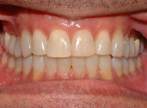 Before and After - Frial Orthodontics