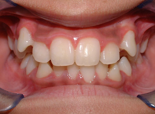 Before and After - Frial Orthodontics